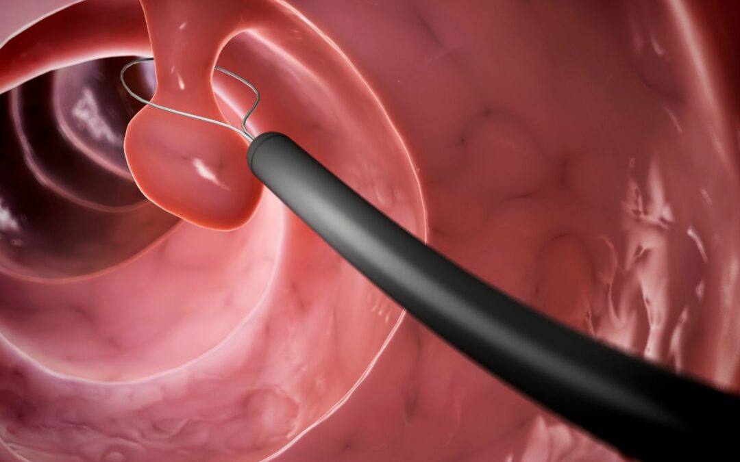 anastomosis is a procedure to remove polyps from a vessel.